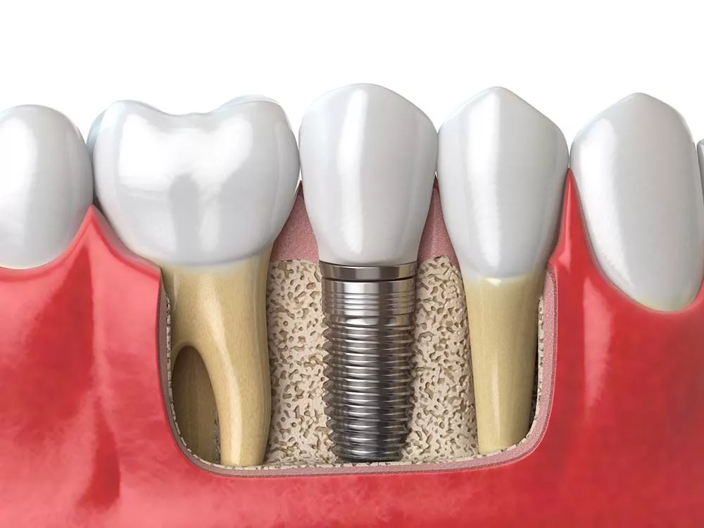 Implant dental