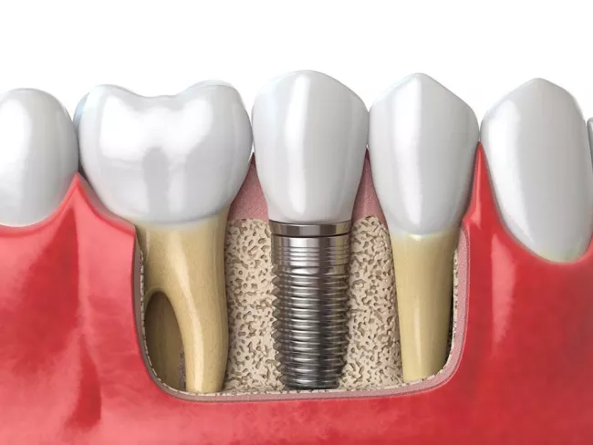 Implant dental
